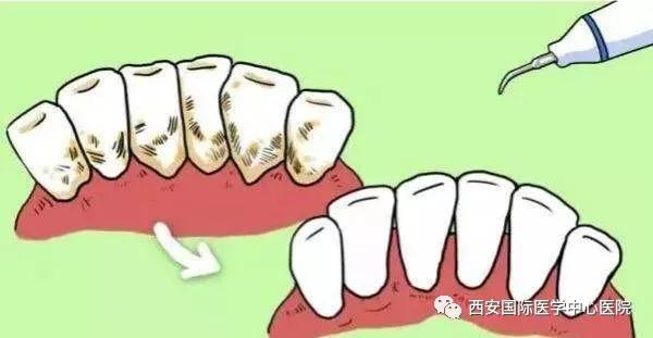 【科普】牙齒上的黃斑好難看，三招告訴你如何預(yù)防氟斑牙
