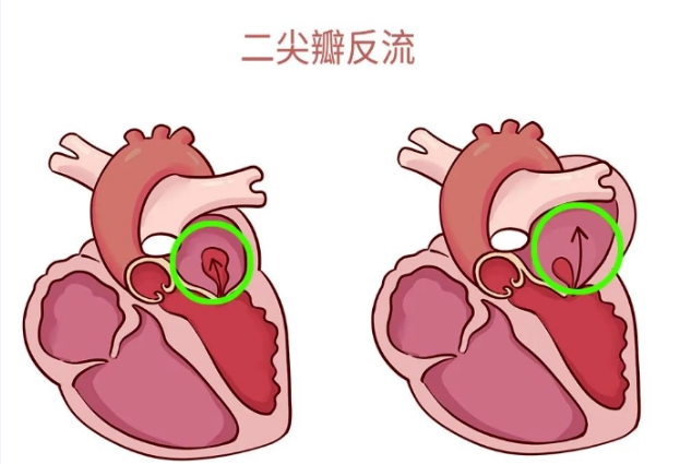 體檢報(bào)告里的心臟瓣膜反流，你讀懂了嗎？