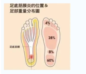 每年新生數(shù)百萬足底筋膜炎患者！國(guó)際醫(yī)學(xué)專家提醒：跑步要選擇合適的鞋